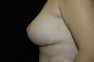 Breast Revision 1d